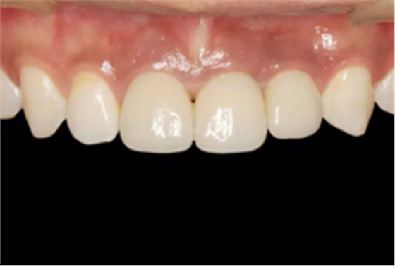 【病例分享】上颌多颗相邻前牙的“精确化”即刻种植修复一例 【病例分享】上颌多颗相邻前牙的“精确化”即刻种植修复一例