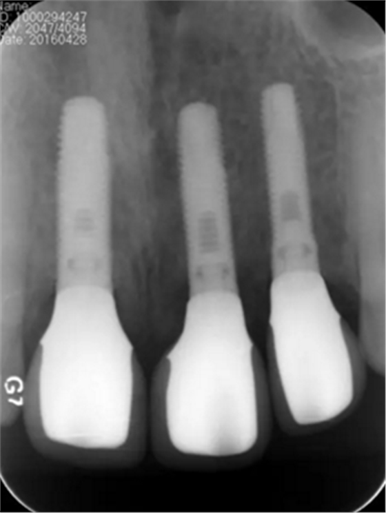 【病例分享】上颌多颗相邻前牙的“精确化”即刻种植修复一例 【病例分享】上颌多颗相邻前牙的“精确化”即刻种植修复一例