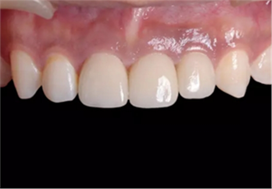 【病例分享】上颌多颗相邻前牙的“精确化”即刻种植修复一例 【病例分享】上颌多颗相邻前牙的“精确化”即刻种植修复一例
