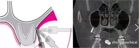 特殊植入部位及注意事项