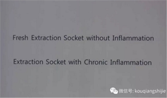 拔牙窝的处理-新思路 拔牙窝的处理-新思路