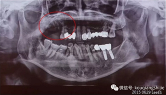 拔牙窝的处理-新思路 拔牙窝的处理-新思路