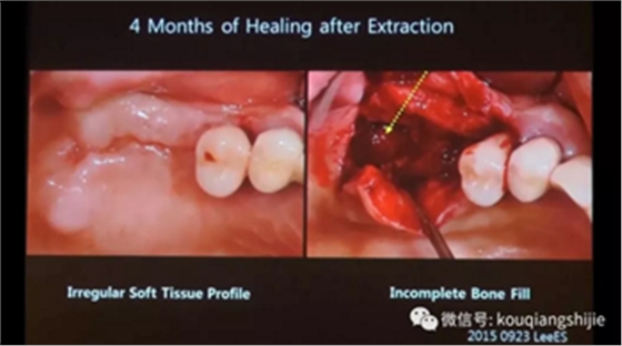 拔牙窝的处理-新思路 拔牙窝的处理-新思路