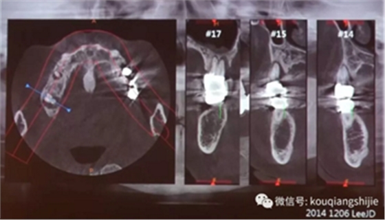 拔牙窝的处理-新思路 拔牙窝的处理-新思路