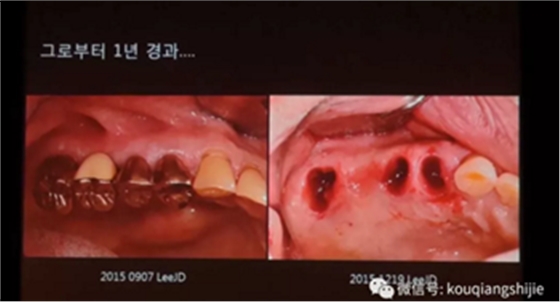 拔牙窝的处理-新思路 拔牙窝的处理-新思路