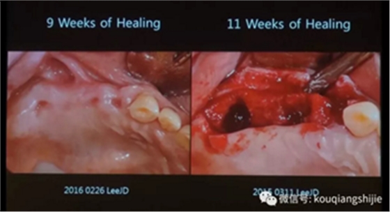 拔牙窝的处理-新思路 拔牙窝的处理-新思路