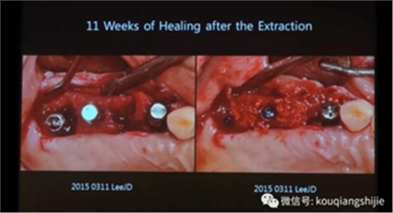 拔牙窝的处理-新思路 拔牙窝的处理-新思路
