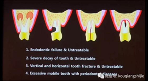 拔牙窝的处理-新思路 拔牙窝的处理-新思路