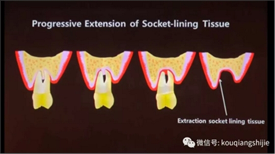 拔牙窝的处理-新思路 拔牙窝的处理-新思路