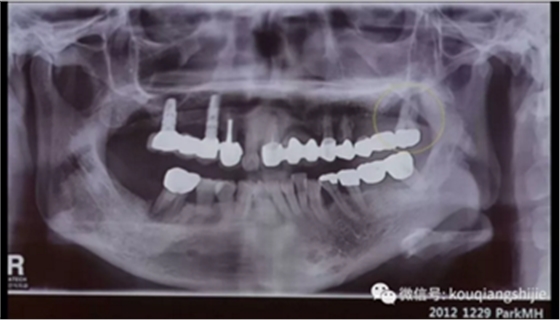 拔牙窝的处理-新思路 拔牙窝的处理-新思路