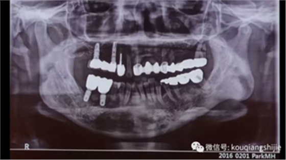 拔牙窝的处理-新思路 拔牙窝的处理-新思路