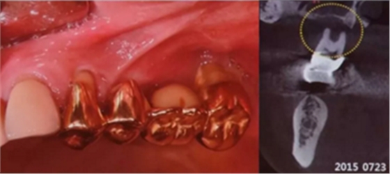 拔牙窝的处理-新思路 拔牙窝的处理-新思路