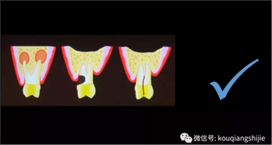 拔牙窝的处理-新思路 拔牙窝的处理-新思路