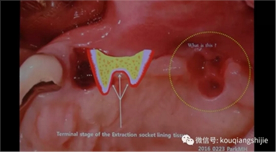 拔牙窝的处理-新思路 拔牙窝的处理-新思路