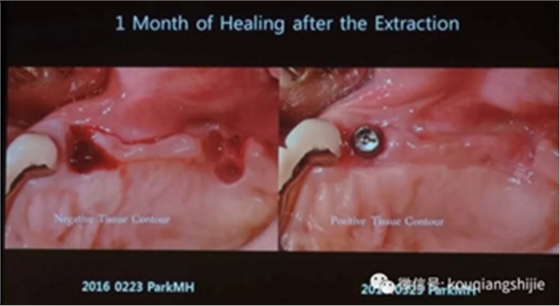 拔牙窝的处理-新思路 拔牙窝的处理-新思路