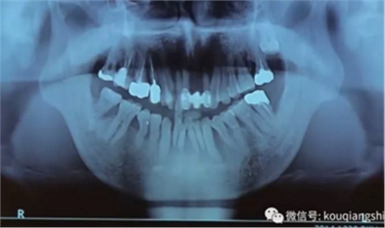 拔牙窝的处理-新思路 拔牙窝的处理-新思路