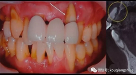 拔牙窝的处理-新思路 拔牙窝的处理-新思路