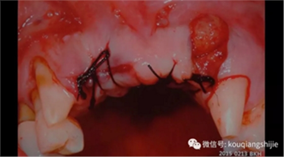 拔牙窝的处理-新思路 拔牙窝的处理-新思路