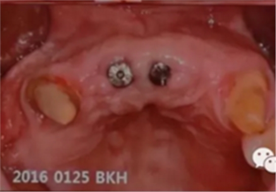 拔牙窝的处理-新思路 拔牙窝的处理-新思路