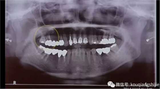 拔牙窝的处理-新思路 拔牙窝的处理-新思路
