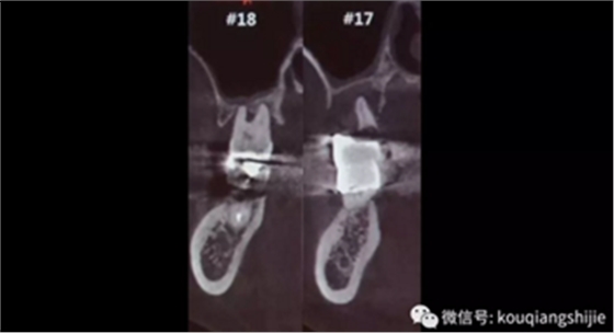 拔牙窝的处理-新思路 拔牙窝的处理-新思路