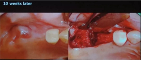 拔牙窝的处理-新思路 拔牙窝的处理-新思路