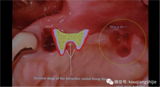 拔牙窝的处理-新思路 拔牙窝的处理-新思路