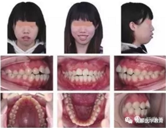 病例精选 | 骨性Ⅱ类高角面型矫治病例