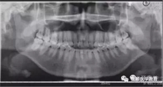 病例精选 | 骨性Ⅱ类高角面型矫治病例