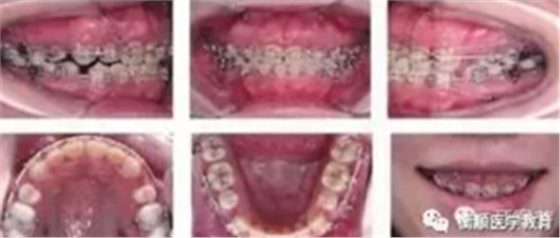 病例精选 | 骨性Ⅱ类高角面型矫治病例