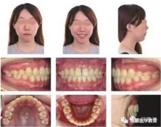 病例精选 | 骨性Ⅱ类高角面型矫治病例