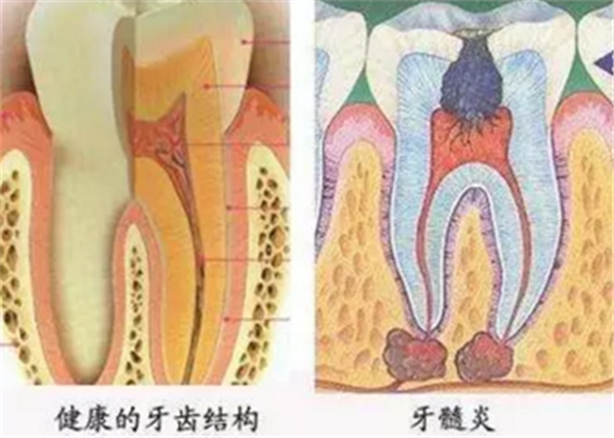 牙髓症状的鉴别