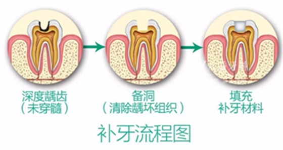 完全不懂，各种补牙材料，到底怎么选？