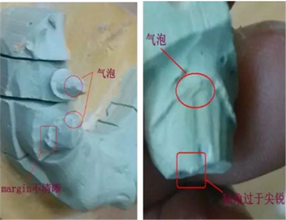 全锆牙冠裂原因分析—操作流程工艺以及患者日常使用