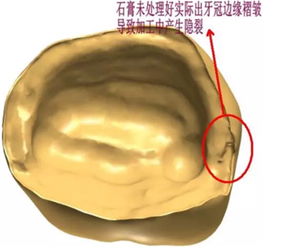 全锆牙冠裂原因分析—操作流程工艺以及患者日常使用