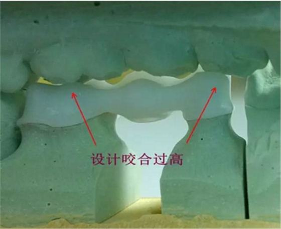 全锆牙冠裂原因分析—操作流程工艺以及患者日常使用