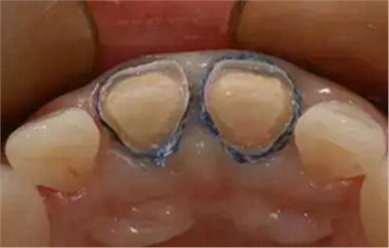 双线排龈在口腔临床冠修复上的应用