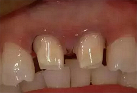 双线排龈在口腔临床冠修复上的应用