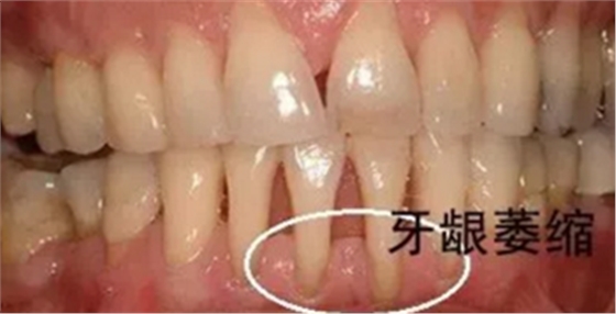 最可怕的牙病——牙龈萎缩