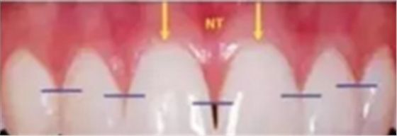 美学种植治疗---软组织的处理
