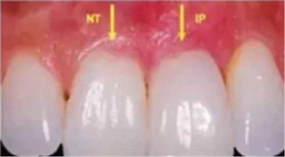 美学种植治疗---软组织的处理
