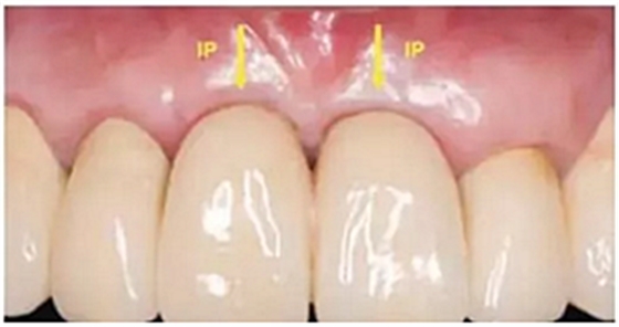 美学种植治疗---软组织的处理