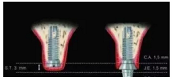 美学种植治疗---软组织的处理