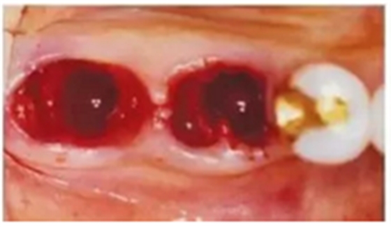 美学种植治疗---软组织的处理