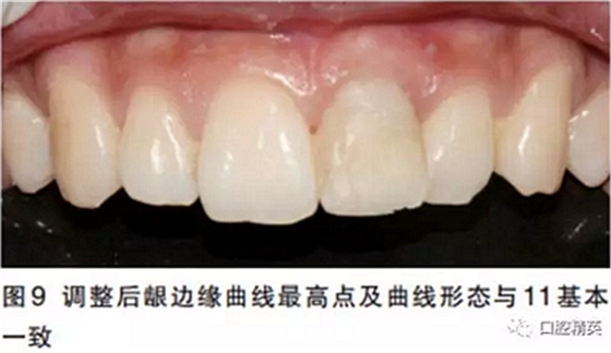 前牙即刻种植并个性化基台美学修复