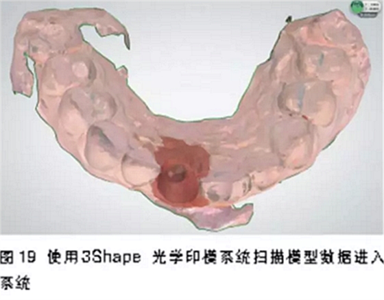 前牙即刻种植并个性化基台美学修复