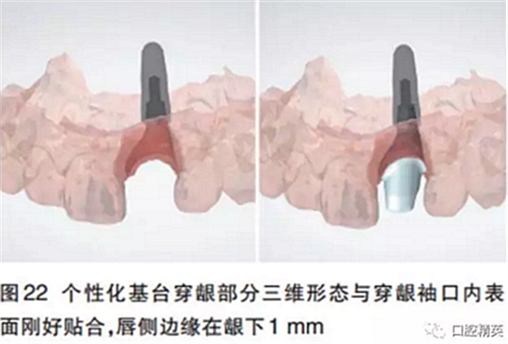 前牙即刻种植并个性化基台美学修复