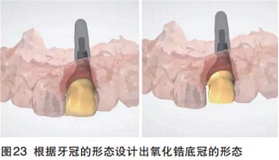 前牙即刻种植并个性化基台美学修复