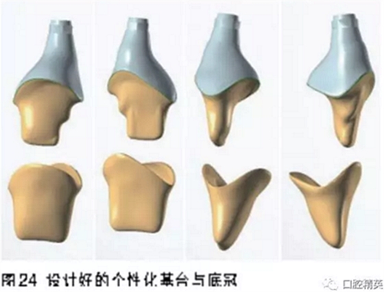 前牙即刻种植并个性化基台美学修复