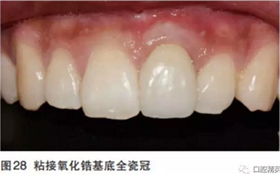 前牙即刻种植并个性化基台美学修复